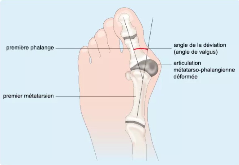 déformation hallux valgus